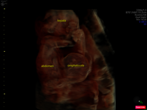 omphalocele-le.png