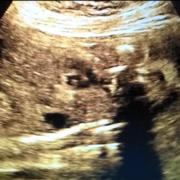 diaphragmatic-hernia.png