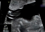 double-aortic-arch.jpg