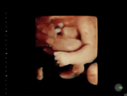 pentalogia-cantrell-35-sem-31volcine.png