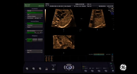 Voluson Signature Series: STIC acquisition of the fetal  ...