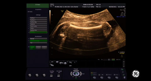Voluson Signature Series: Fractional limb volume