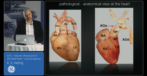 Advanced VISUS: STIC Volume Ultrasound of the fetal heart- ...