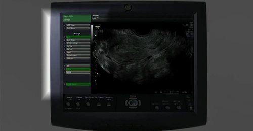 Voluson Performance Series: 3D Gynecology