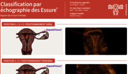 Classification par échographie des Essure 