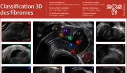 Classification 3D des fibromes 