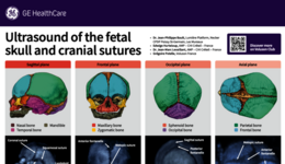 Ultrasound of the fetal skull and cranial sutures