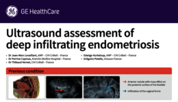 Ultrasound assessment of deep infiltrating endometriosis