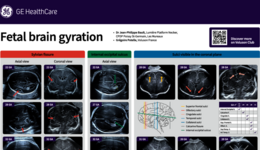 Fetal brain gyration