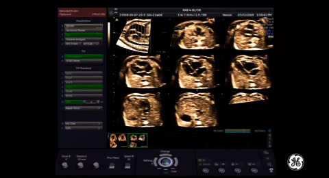 Voluson Signature Series: Transposition of the great arteries