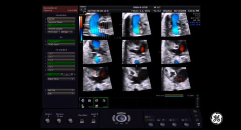 Voluson Signature Series: Hypoplastic left heart syndrome