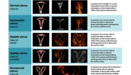 Classification of Uterine Anomalies