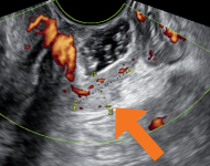 Evaluating Endometriosis