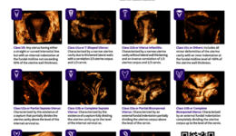  ESHRE | ESGE Classification of Uterine Anomalies