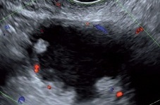 Ultrasound in Gynecological Oncology