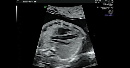 Tiny Tickers - LVOT