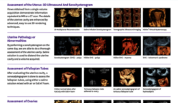 One visit infertility workup. A Protocol for 3D Ultrasound ...