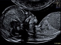 Role of High Frequency imaging 
