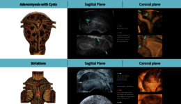 Poster Adenomyosis (EN)
