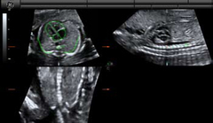 SonoVCADheart
