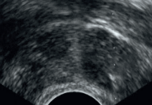 Tru-cut Biopsy in Gynecological Oncology 