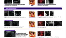 Endometriosis Poster (EN)