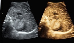 VCI-A: Volume Contrast Imaging in Real Time